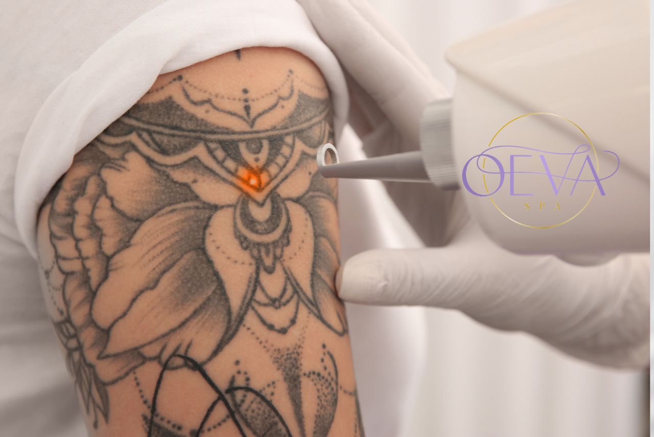 Eliminación de tatuajes oeva spa Eliminación de tatuajes oeva spa
