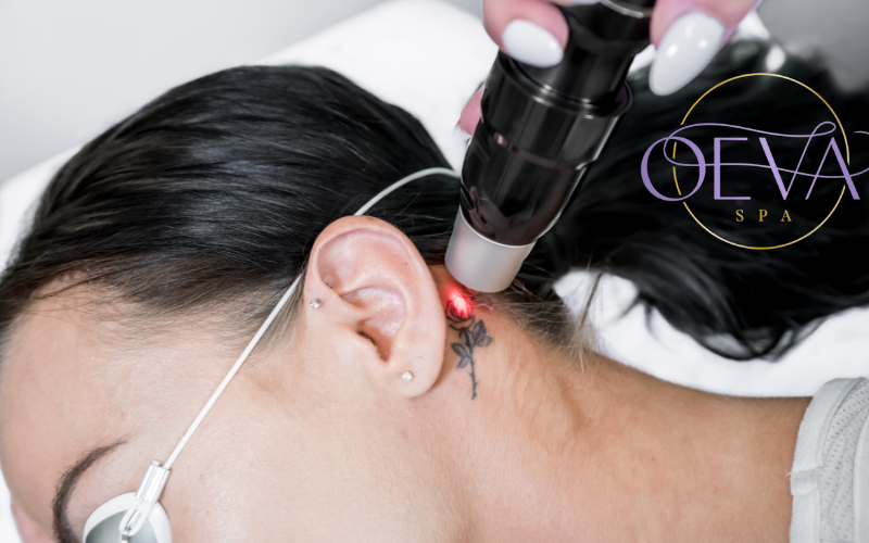 Eliminación de tatuajes oeva spa Eliminación de tatuajes
